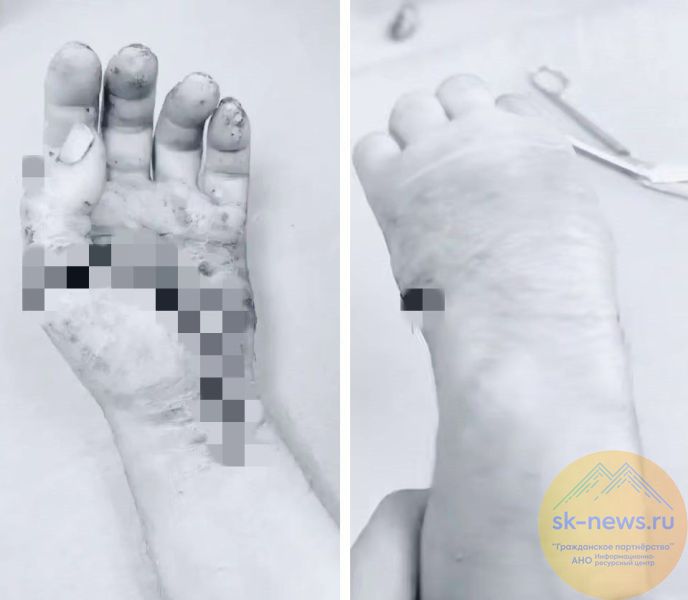 В Пятигорске врачи пришили обратно практически отпиленную кисть руки