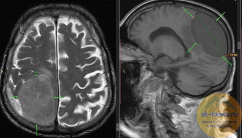 В Пятигорске пенсионеру удалили гигантскую опухоль мозга, которая парализовала половину тела